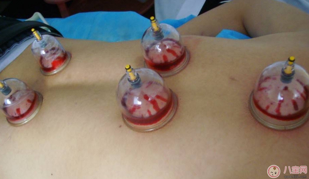 孕婦拔火罐可以嗎 孕婦肩膀能拔火罐嗎(孕婦拔過(guò)火罐怎么辦)