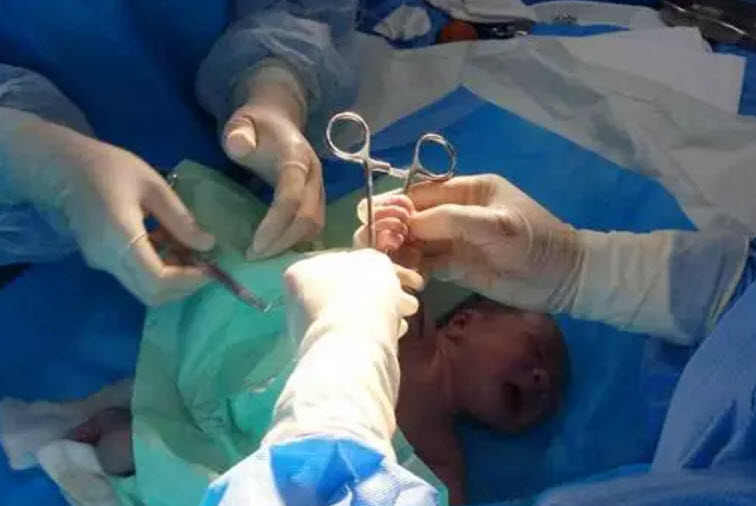 剪臍帶時寶寶會不會疼 剪臍帶是寶寶疼還是媽媽疼