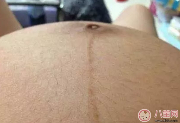 孕婦懷孕后身體哪個(gè)部位容易變黑呢 孕婦變黑對(duì)寶寶會(huì)有什么影響嗎 孕婦懷孕后身體哪個(gè)部位容易變黑呢 孕婦變黑對(duì)寶寶會(huì)有什么影響嗎