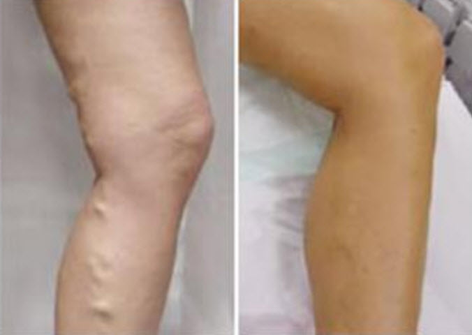 孕婦靜脈曲張是怎么回事 孕婦靜脈曲張?jiān)趺淳徑? alt=