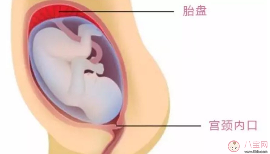 孕婦胎盤(pán)低怎么辦 孕婦胎盤(pán)低是什么原因造成的(胎盤(pán)低要注意什么)