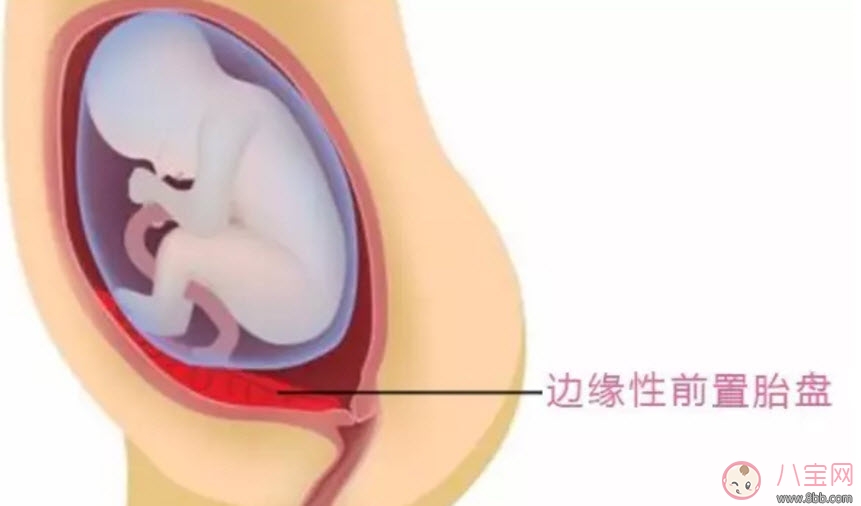 孕婦胎盤(pán)低怎么辦 孕婦胎盤(pán)低是什么原因造成的(胎盤(pán)低要注意什么)