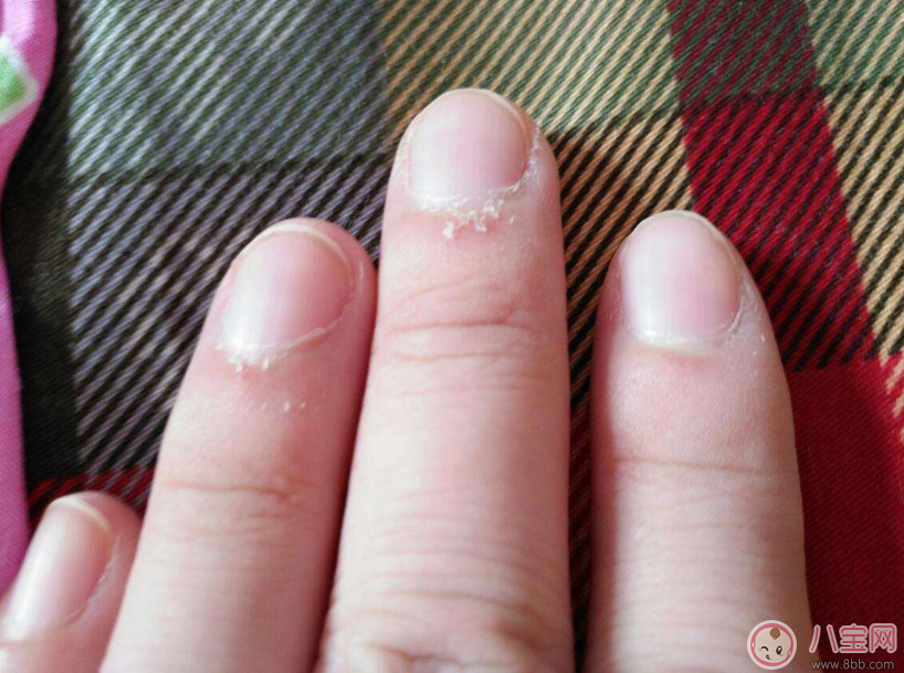 手上長這個千萬不要撕 倒刺的正確處理方法 手上長這個千萬不要撕 倒刺的正確處理方法