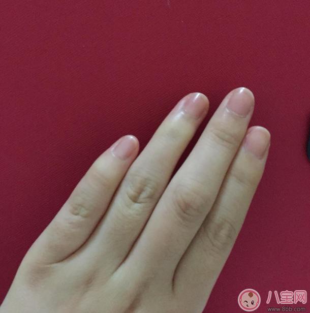 手上長這個千萬不要撕 倒刺的正確處理方法 手上長這個千萬不要撕 倒刺的正確處理方法