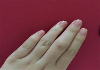 手上長這個(gè)千萬不要撕 倒刺的正確處理方法