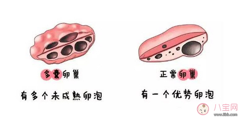 昆凌三胎計(jì)劃，昆凌多囊性卵巢癥候群是什么病