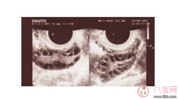 昆凌三胎計(jì)劃，昆凌多囊性卵巢癥候群是什么病