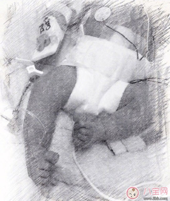 侯佩岑二胎ABO新生兒溶血癥是什么 寶寶ABO溶血癥可以預(yù)防嗎