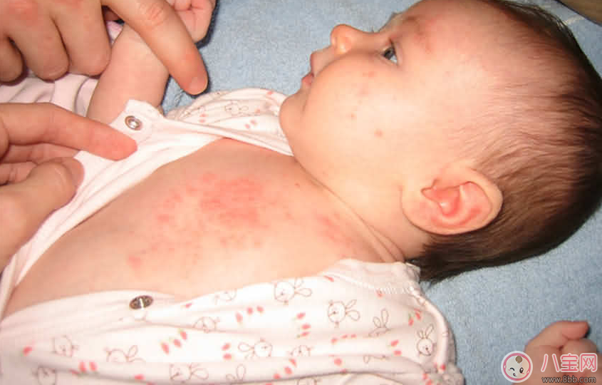 寶寶痱子總不消 用用這個準(zhǔn)會好
