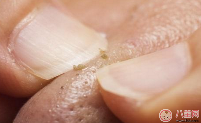 抿嘴時下巴上面的白色小顆粒是不是粉刺 抿嘴時下巴上面的白色小顆粒是不是粉刺