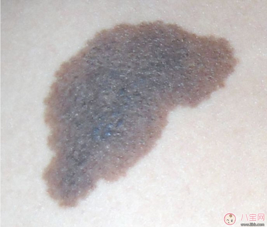 嬰兒屁股下面有胎記有什么含義 新生兒寶寶屁股下面有胎記好不好