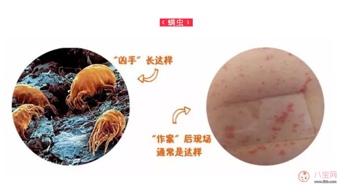 寶寶螨蟲過(guò)敏怎么辦，寶寶被螨蟲咬和蚊子咬癥狀對(duì)比圖片區(qū)別