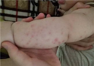 寶寶螨蟲過敏怎么辦，寶寶被螨蟲咬和蚊子咬癥狀對比圖片區(qū)別