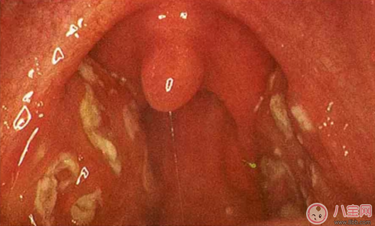 寶寶扁桃體炎表現(xiàn) 如何預(yù)防小兒扁桃體炎 寶寶扁桃體炎表現(xiàn) 如何預(yù)防小兒扁桃體炎