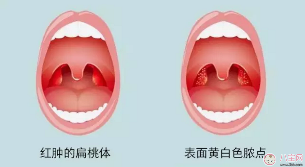 寶寶扁桃體炎表現(xiàn) 如何預(yù)防小兒扁桃體炎 寶寶扁桃體炎表現(xiàn) 如何預(yù)防小兒扁桃體炎