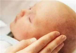 新生兒頭上的乳痂一般什么時候消失 為什么有的寶寶長乳痂有的不長