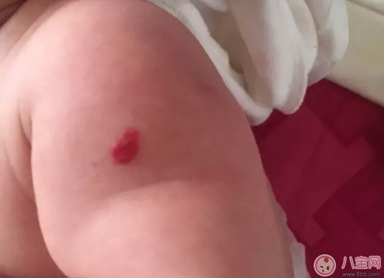 新生兒紅色胎記和血管瘤的對(duì)比方法 寶寶胎記和血管瘤的區(qū)別 新生兒紅色胎記和血管瘤的對(duì)比方法 寶寶胎記和血管瘤的區(qū)別