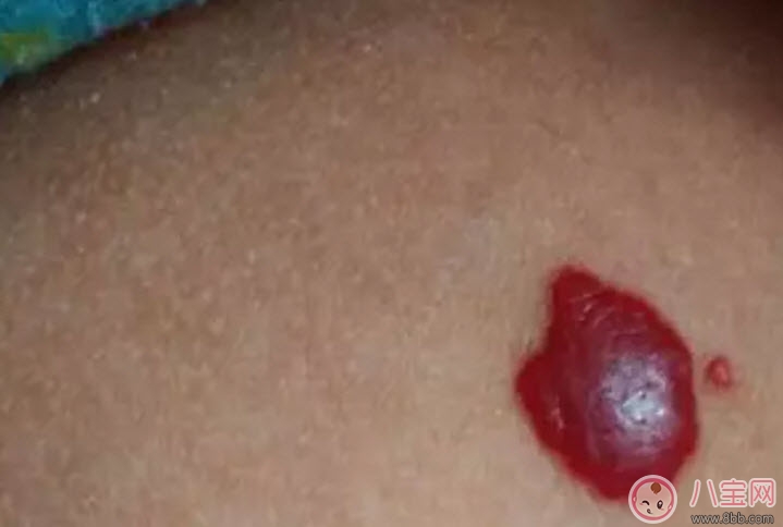新生兒紅色胎記和血管瘤的對(duì)比方法 寶寶胎記和血管瘤的區(qū)別 新生兒紅色胎記和血管瘤的對(duì)比方法 寶寶胎記和血管瘤的區(qū)別