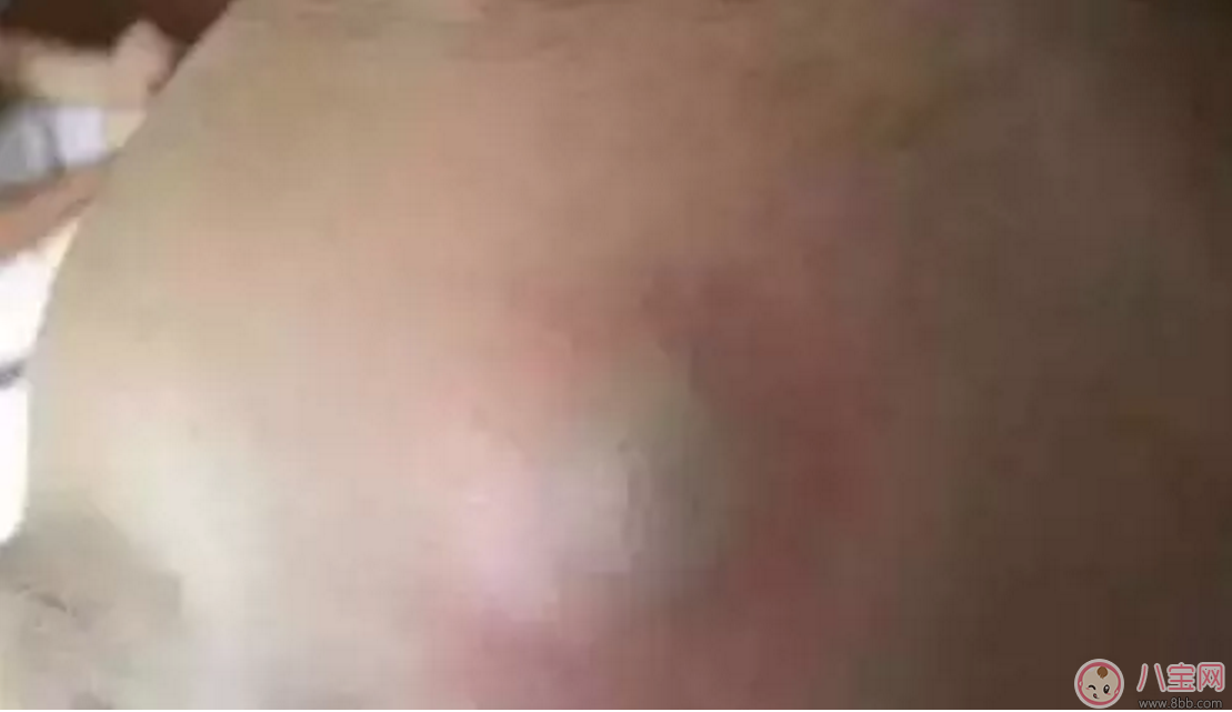 豬油按摩處理傷口致男童休克 這些土方害人不淺