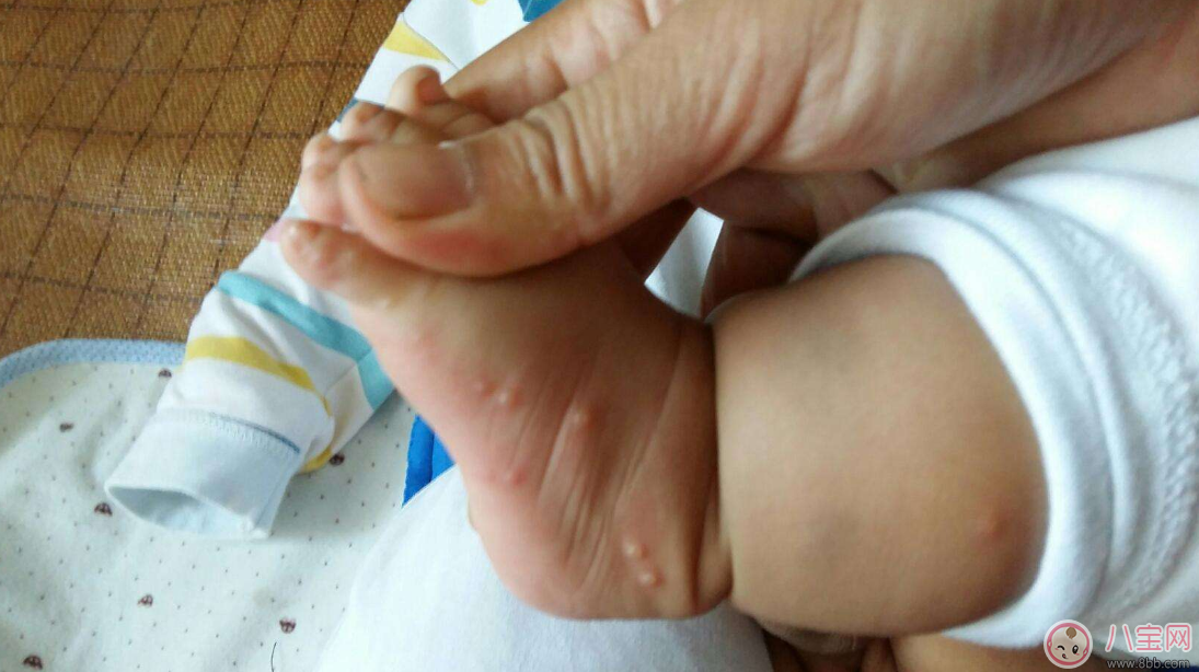 孩子長水痘這些東西千萬遠離 孩子水痘好得快方法