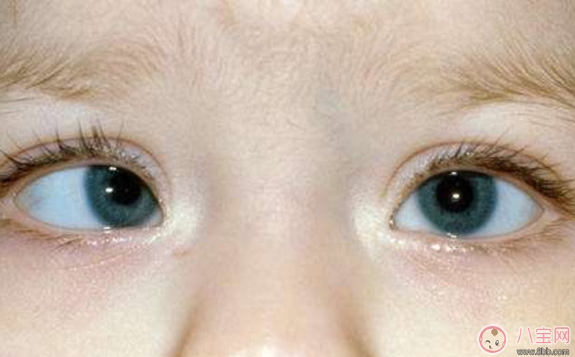 寶寶斜視手術(shù)風(fēng)險(xiǎn)大嗎 寶寶斜視一定要做手術(shù)嗎