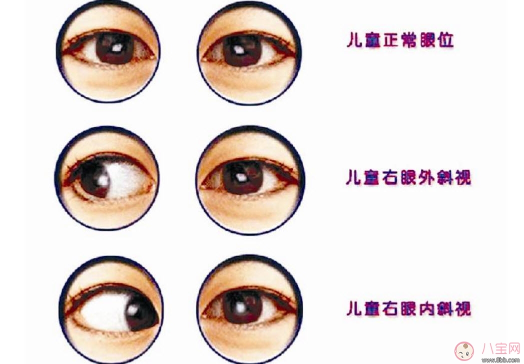 寶寶斜視手術(shù)風(fēng)險(xiǎn)大嗎 寶寶斜視一定要做手術(shù)嗎