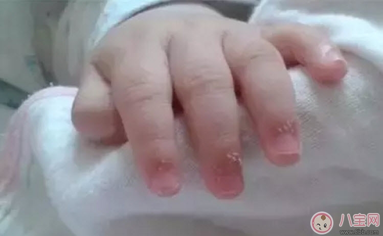 寶寶手上長(zhǎng)肉刺是因?yàn)槿狈I(yíng)養(yǎng)嗎 寶寶手指上長(zhǎng)倒刺是什么原因 寶寶手上長(zhǎng)肉刺是因?yàn)槿狈I(yíng)養(yǎng)嗎 寶寶手指上長(zhǎng)倒刺是什么原因