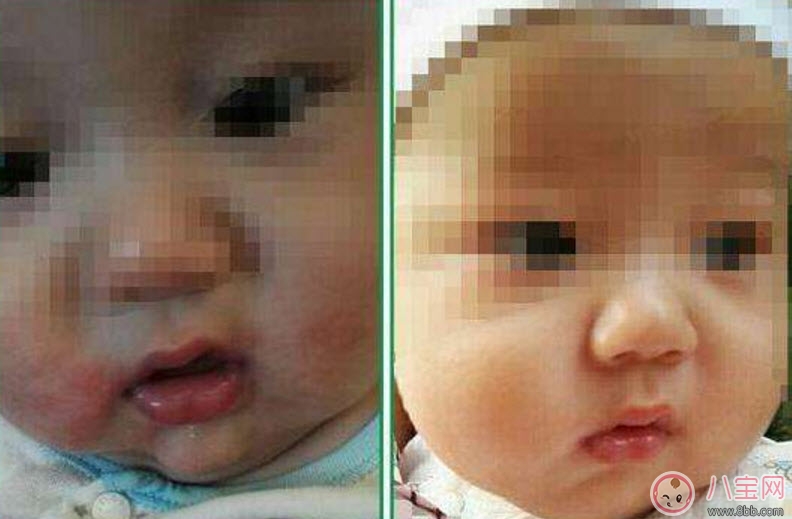 寶寶嘴角邊長(zhǎng)濕疹怎么辦 寶寶嘴角濕疹是什么原因