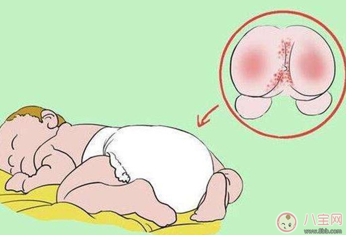 寶寶紅屁股哭鬧怎么辦 寶寶紅屁股安撫物品 寶寶紅屁股哭鬧怎么辦 寶寶紅屁股安撫物品