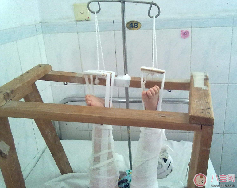 孩子總是容易骨折 孩子骨折后怎么處理