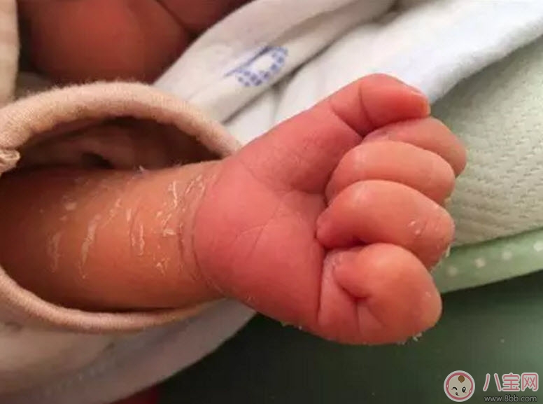 新生兒手腳脫皮要多久 新生兒脫皮怎么護(hù)理(能搽點(diǎn)什么)