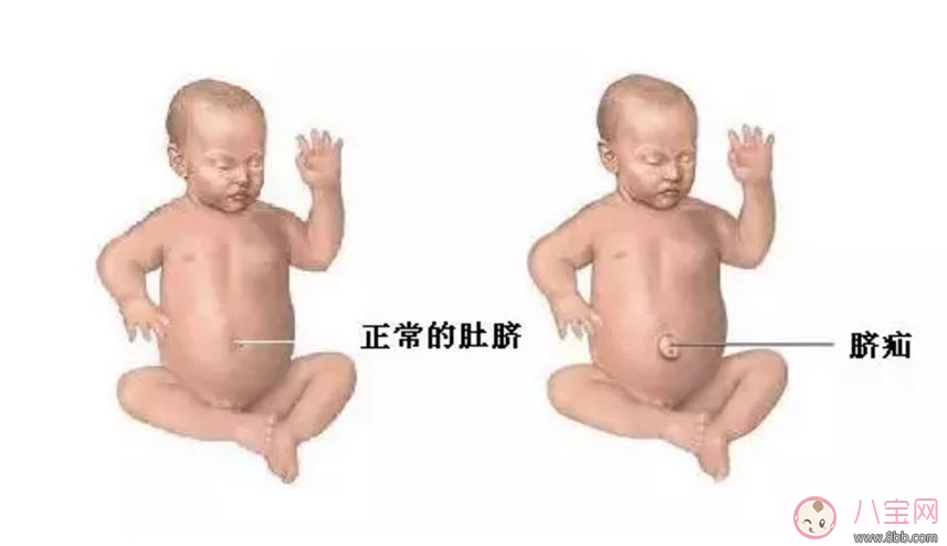 臍疝對寶寶有什么影響 寶寶臍疝是什么原因引起的 臍疝對寶寶有什么影響 寶寶臍疝是什么原因引起的