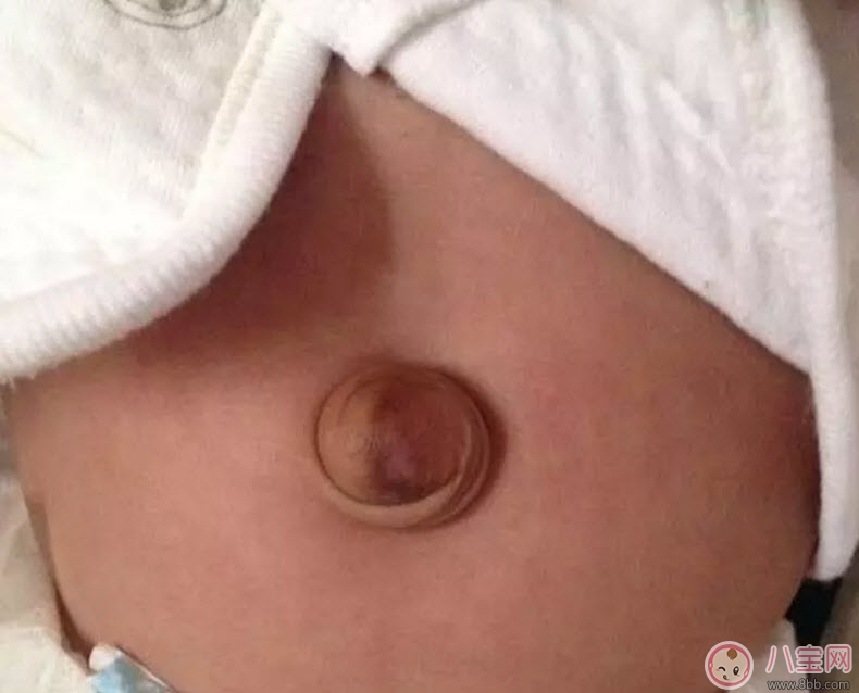 臍疝對寶寶有什么影響 寶寶臍疝是什么原因引起的 臍疝對寶寶有什么影響 寶寶臍疝是什么原因引起的