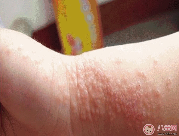 寶寶痱子和濕疹的區(qū)別 寶寶濕疹和痱子最大的不同是什么