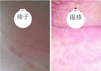 寶寶痱子和濕疹的區(qū)別 寶寶濕疹和痱子最大的不同是什么