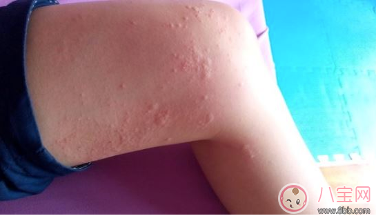 孩子玫瑰疹怎么護(hù)理 細(xì)心護(hù)理好得快