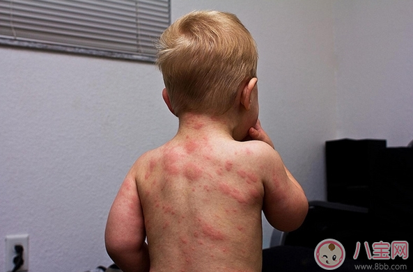 孩子玫瑰疹怎么護(hù)理 細(xì)心護(hù)理好得快