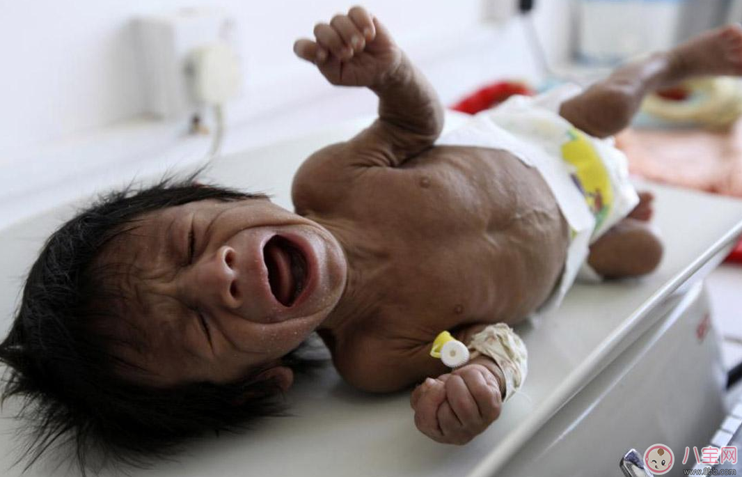 孩子這種情況居然是營養(yǎng)不良的暗示 快給孩子調(diào)整過來 孩子這種情況居然是營養(yǎng)不良的暗示 快給孩子調(diào)整過來