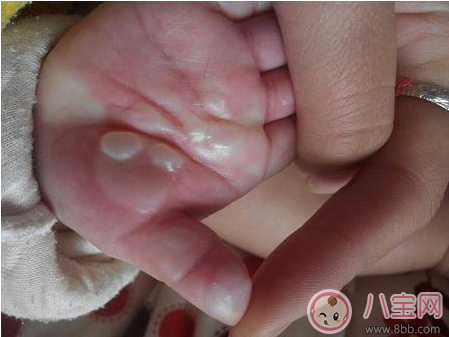 孩子燙傷后抹醬油有效嗎 這些偏方燙傷后千萬不要學(xué)