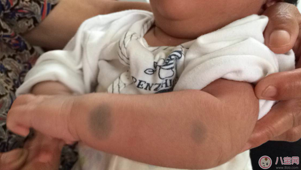 寶寶胎記會(huì)自己掉嗎 寶寶胎記去除方法