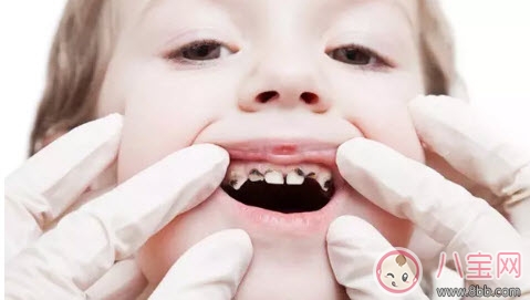 寶寶蛀牙不給醫(yī)生看 如何預(yù)防蛀牙減少寶寶痛苦 寶寶蛀牙不給醫(yī)生看 如何預(yù)防蛀牙減少寶寶痛苦
