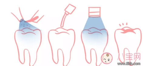 寶寶蛀牙不給醫(yī)生看 如何預(yù)防蛀牙減少寶寶痛苦 寶寶蛀牙不給醫(yī)生看 如何預(yù)防蛀牙減少寶寶痛苦