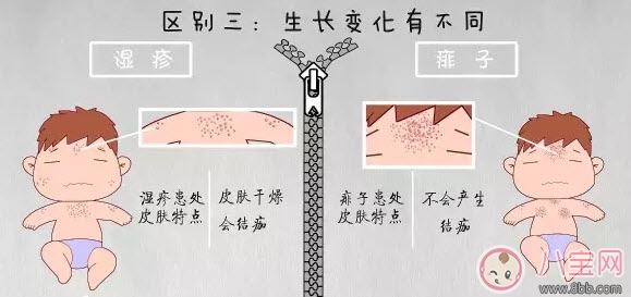 寶寶痱子和濕疹的區(qū)別 濕疹和痱子的區(qū)別圖片