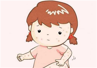 寶寶長(zhǎng)痱子怎么辦 給寶寶去痱子的方法有哪些