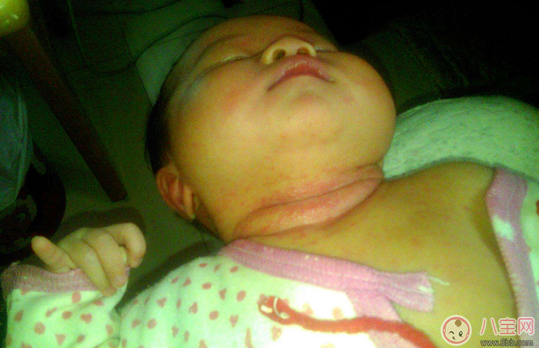 寶寶出汗脖子淹了怎么辦 嬰兒脖子淹了馬上好的土方法 寶寶出汗脖子淹了怎么辦 嬰兒脖子淹了馬上好的土方法