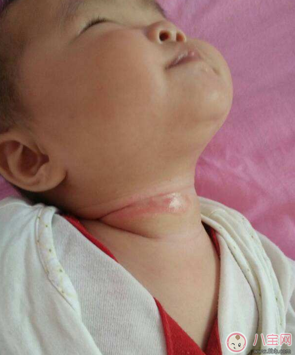 寶寶出汗脖子淹了怎么辦 嬰兒脖子淹了馬上好的土方法 寶寶出汗脖子淹了怎么辦 嬰兒脖子淹了馬上好的土方法