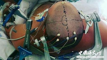 古代人有開顱手術(shù)嗎 古代人治療腦科疾病的方法