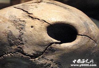 古代人有開顱手術(shù)嗎 古代人治療腦科疾病的方法