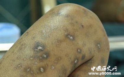 艾滋病來源之謎：艾滋病病毒是怎么衍生出來的