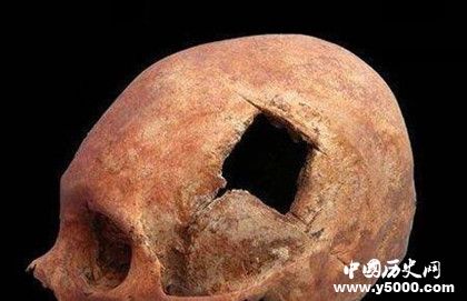 古代人有開顱手術(shù)嗎 古代人治療腦科疾病的方法